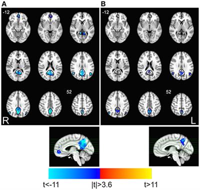 Task-Related Modulations of BOLD Low-Frequency Fluctuations within the Default Mode Network